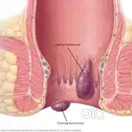 പൈൽസ്(മൂലക്കുരു) ayurveda ആയുർവേദം, (100% ഫലപ്രദം)