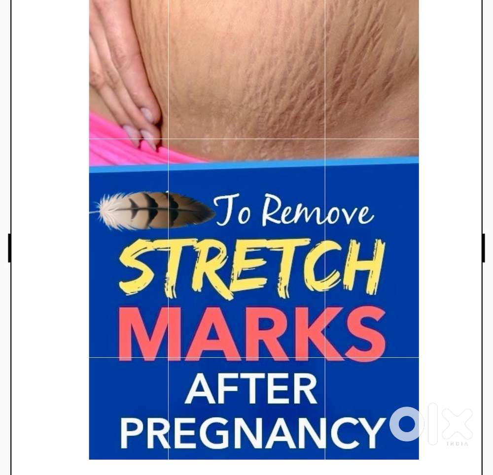 Stretch marks remover