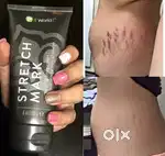 Stretch marks remov cream