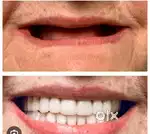 Complete denture and removable partial denture