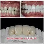 Zirconia tooth best quality