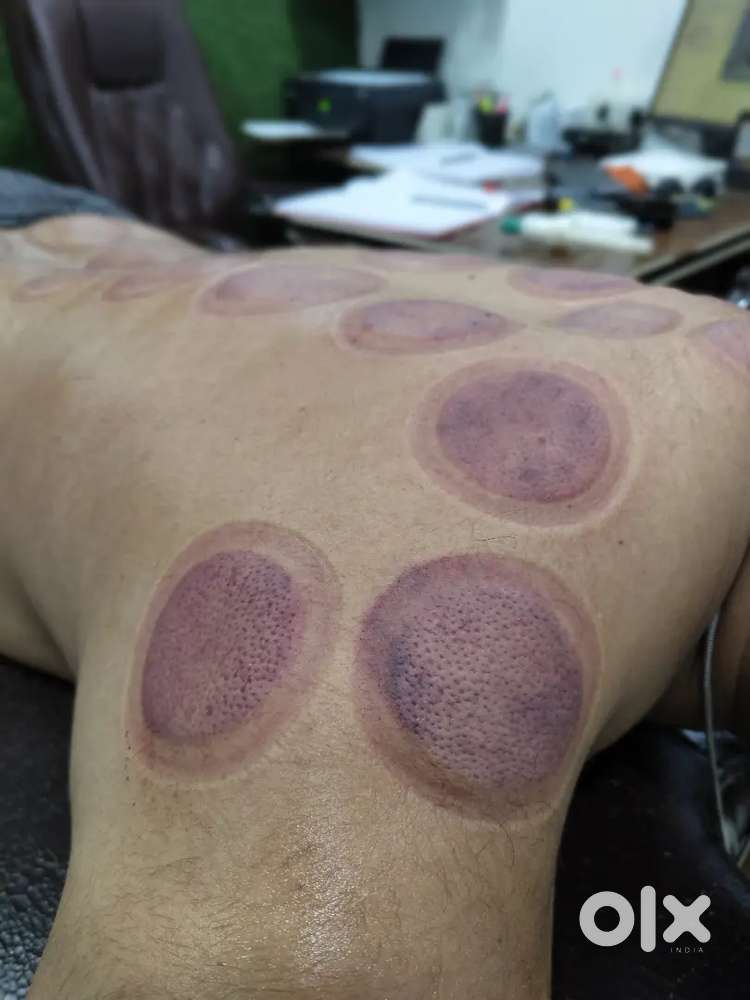 Cupping Therapy