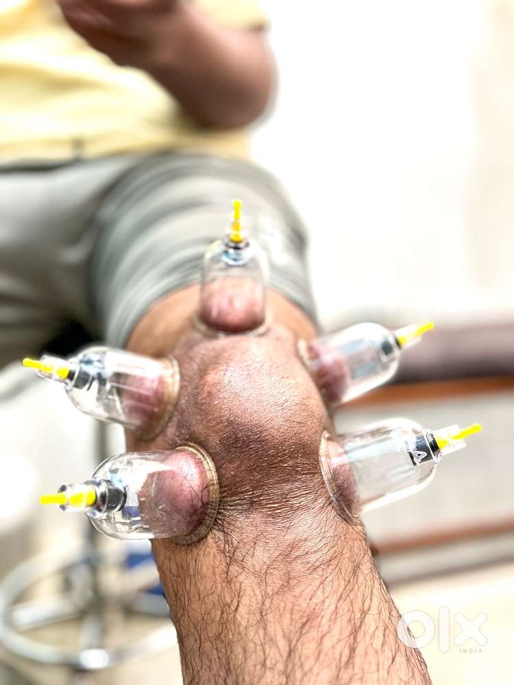 Cupping Therapy