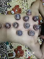Cupping therapy