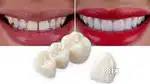 Zirconia teeth